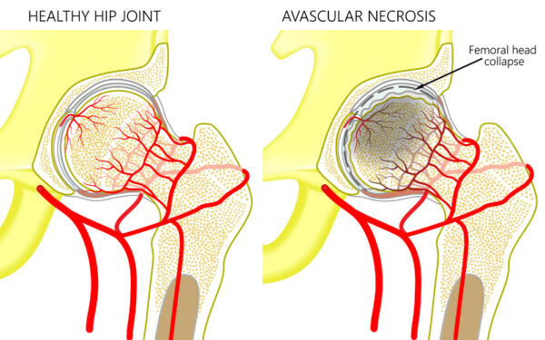 Core Decompression Hip Doctor Sugar Land Pearland Houston Tx