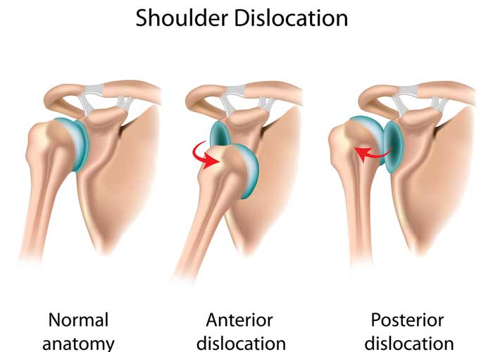Shoulder Dislocation | Houston TX