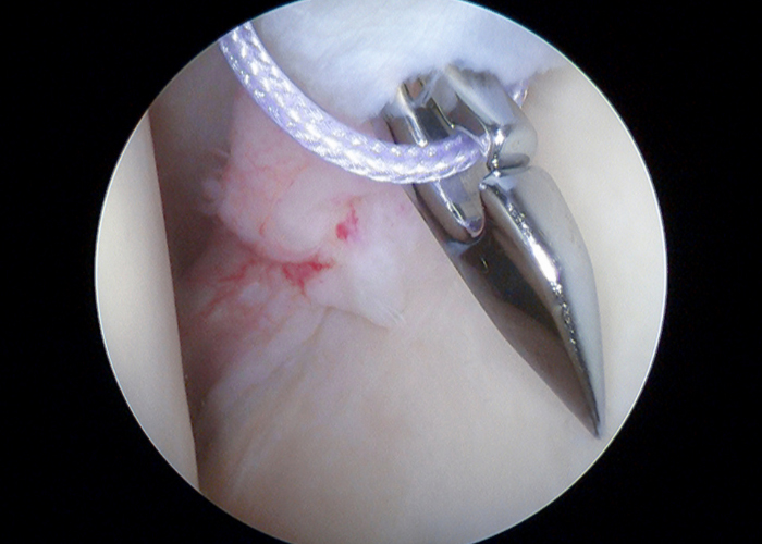 Biceps Surgery