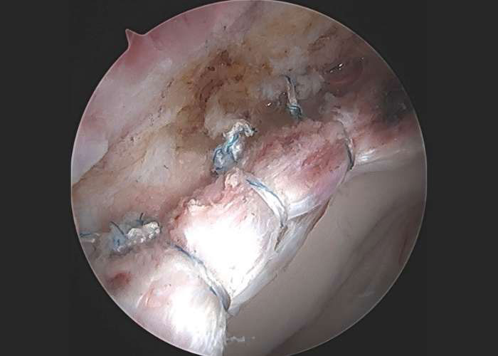Hip Labrum Repair, Surgical View | Ronak Patel, MD