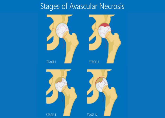 Petition · AVN - RAISE AWARENESS OF AVASCULAR NECROSIS ·