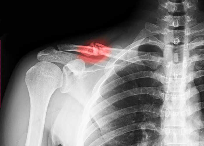 Clavicle Fracture | Houston TX