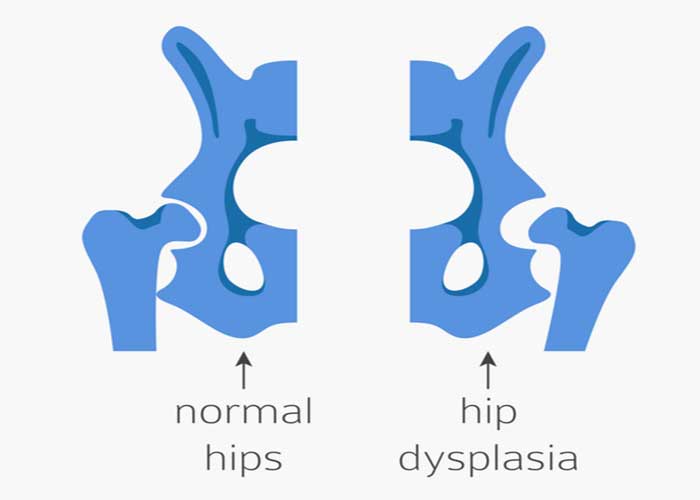 Hip Dysplasia | Houston TX