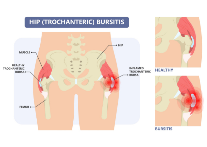 Trochanteric Bursitis | Houston TX