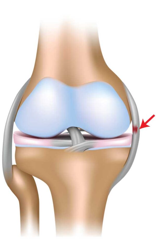 Medial Collateral Ligament Injury, Knee Specialist