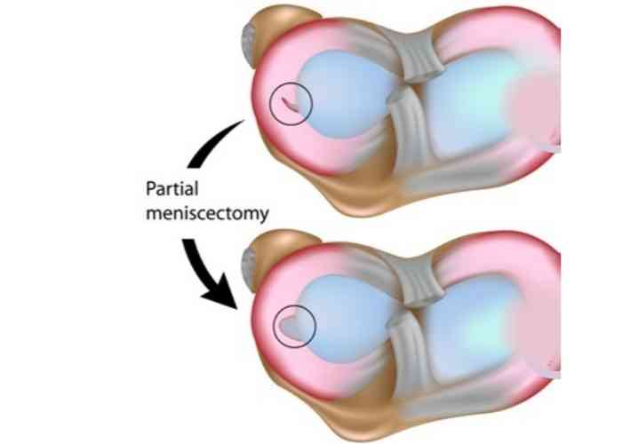 Partial Meniscectomy Illistration | Houston TX