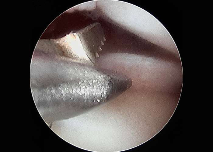 Meniscal biter in use during an arthroscopy
