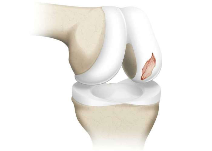 Articular Cartilage Injury Restoration