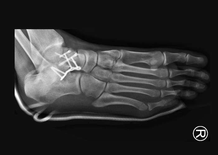 Ankle Fracture Fixation Ankle Fracture Fixation Houston, TX