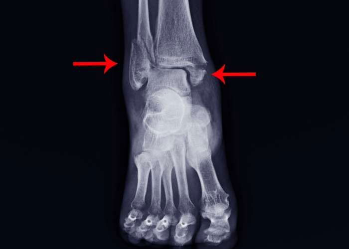 Severe Ankle Fracture | Houston, TX