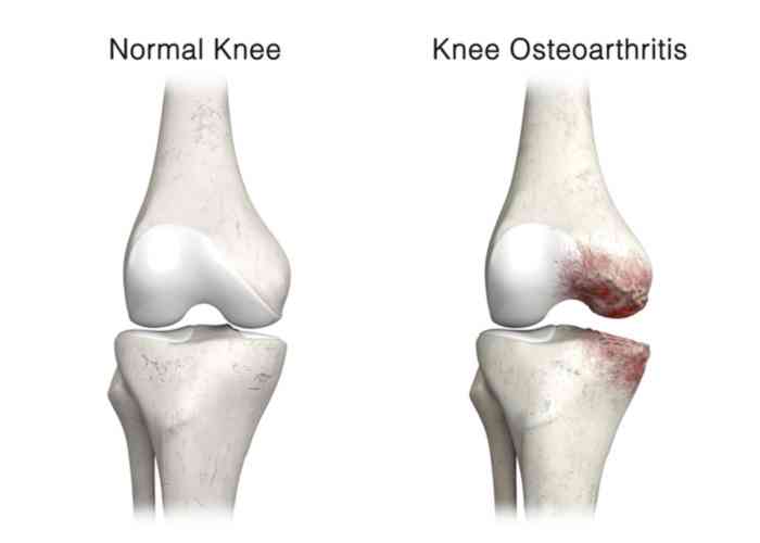 knee Osteoarthritis | Houston, TX