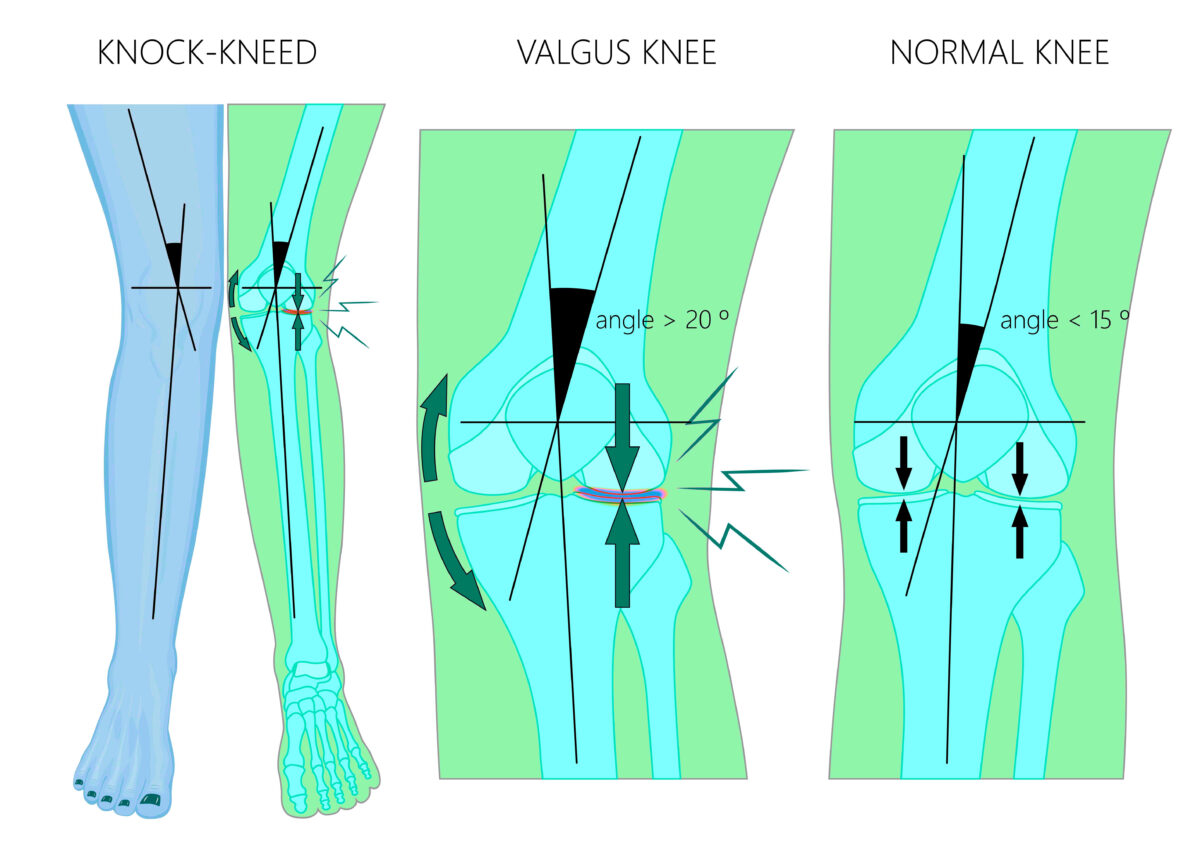 kneecap alignment